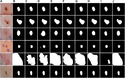 BiDFDC-Net: a dense connection network based on bi-directional feedback for skin image segmentation